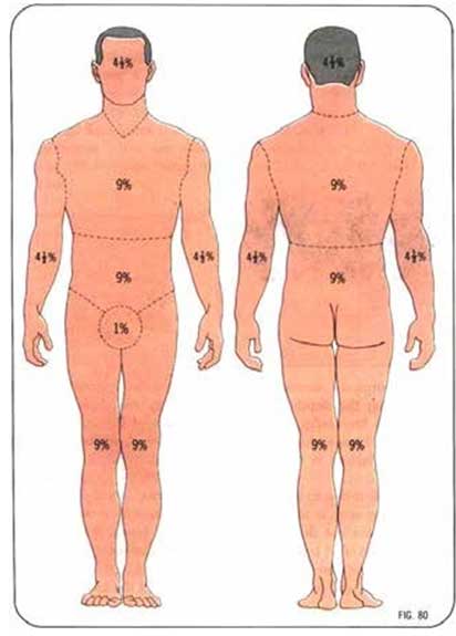 Diện tích da của cơ thể dựa theo quy tắc số 9