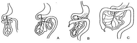 Quá trình ruột xoay trong phát triển bào thai