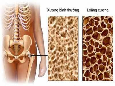 Loãng xương là bệnh lý xương khớp có tính chất toàn thân do chất lượng xương bị giảm