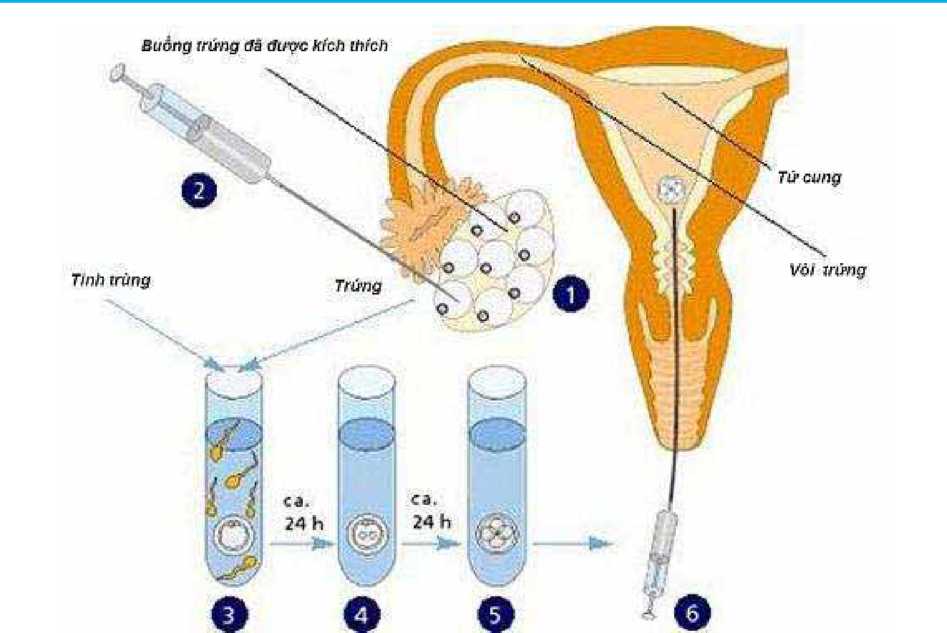 Phương pháp Thụ tinh trong ống nghiệm