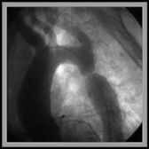 Hình ảnh chụp mạch Hẹp eo động mạch chủ