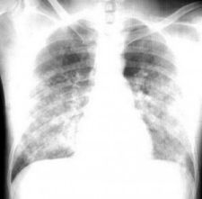 X quang phù phổi cấp