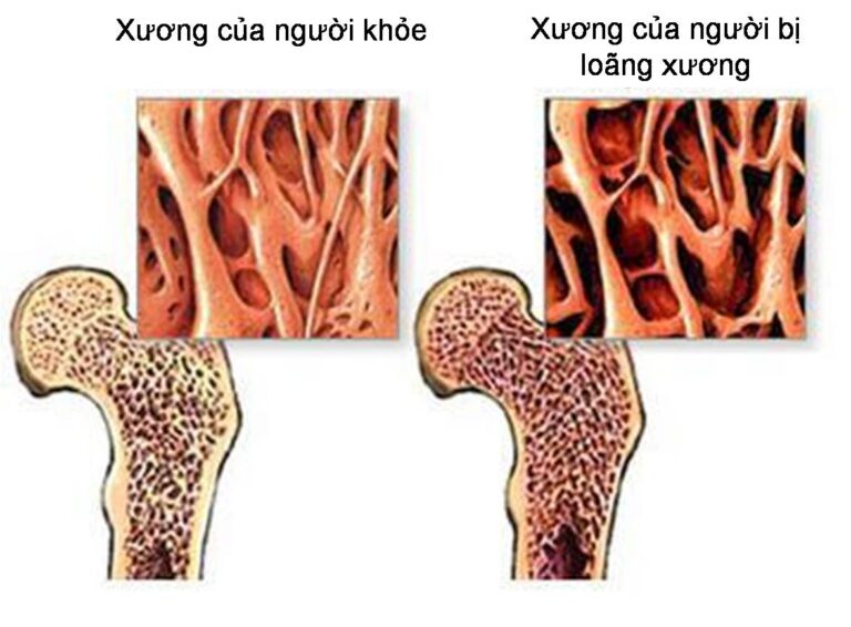 Bệnh Loãng xương – triệu chứng và điều trị