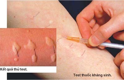 soc-phan-ve-khi-tiem-khang-sinh