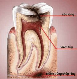 Bệnh viêm tủy răng là nguyên nhân hàng đầu dẫn đến đau nhức răng