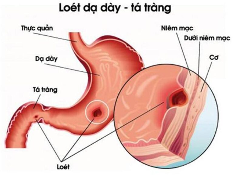 Hình ảnh Loét dạ dày tá tràng