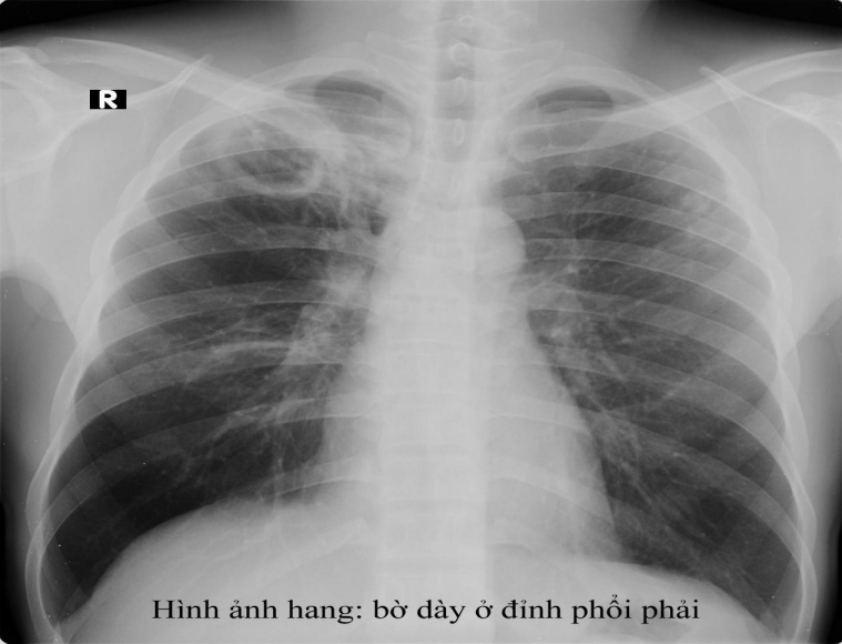 X quang trong chẩn đoán lao phổi