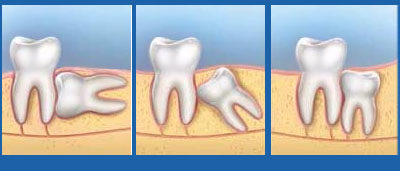 Răng khôn mọc lệch ngầm dưới xương