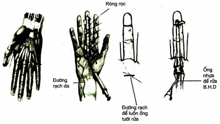 Các đường rạch và phương pháp dẫn lưu mủ bao hoạt dịch gân gấp