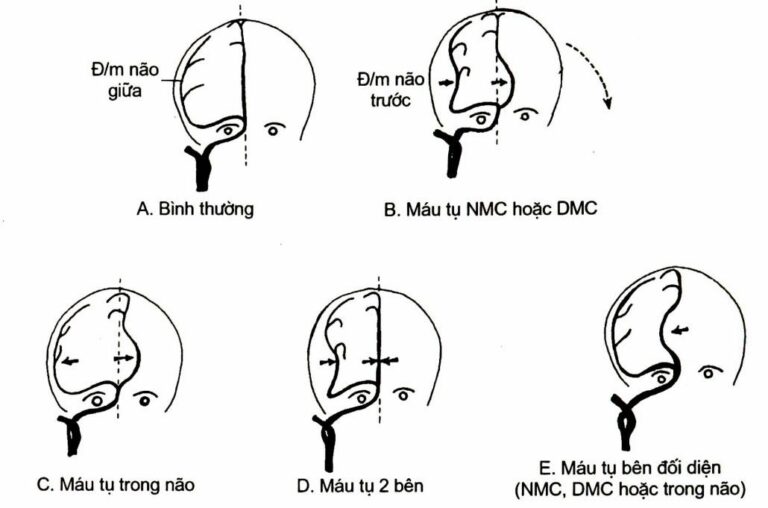 Máu tụ hai bên