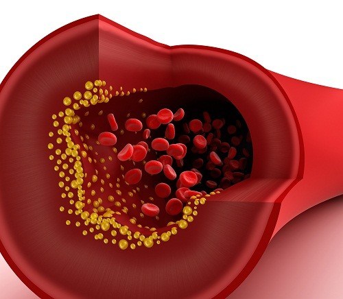 rối loạn lipid máu là một trong những nguyên nhân gây nên các mảng bám thành động mạch