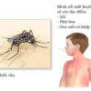 Triệu chứng dengue xuất huyết thể điển hình (độ II)