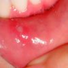 Bệnh loét miệng – nguyên nhân, triệu chứng, điều trị Đông y