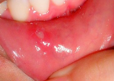 Bệnh loét miệng – nguyên nhân, triệu chứng, điều trị Đông y