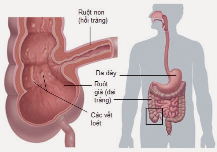 Bệnh Crohn là bệnh khó chẩn đoán 