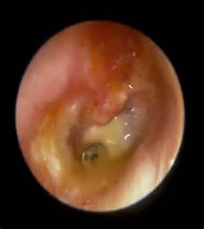 Chảy tai (chảy mủ tai) – Nguyên nhân, cách khám và điều trị