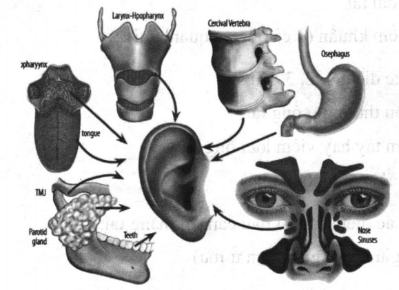 Sơ đồ các tổn thương có thể gây đau tai