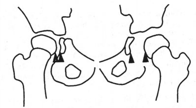 Khoảng cách giọt nước mắt là khoảng giữa phần được cốt hóa của cổ hoặc đầu xương đùi