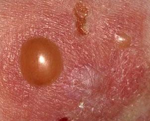Bệnh Pemphigus là một bệnh da phổ biến có bóng nước