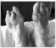 Một số hình ảnh và x quang của bệnh gout