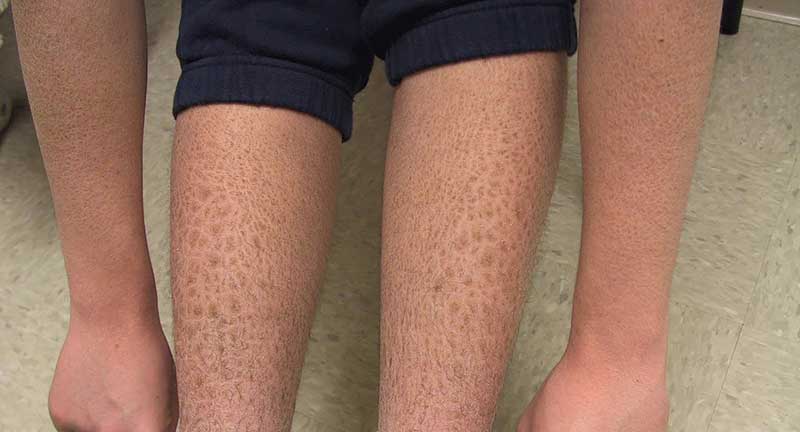 Bệnh da vảy cá (Ichthyosis)