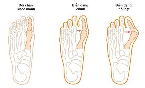 biến dạng khớp bàn ngón chân cái