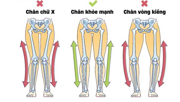 Chân vòng kiềng