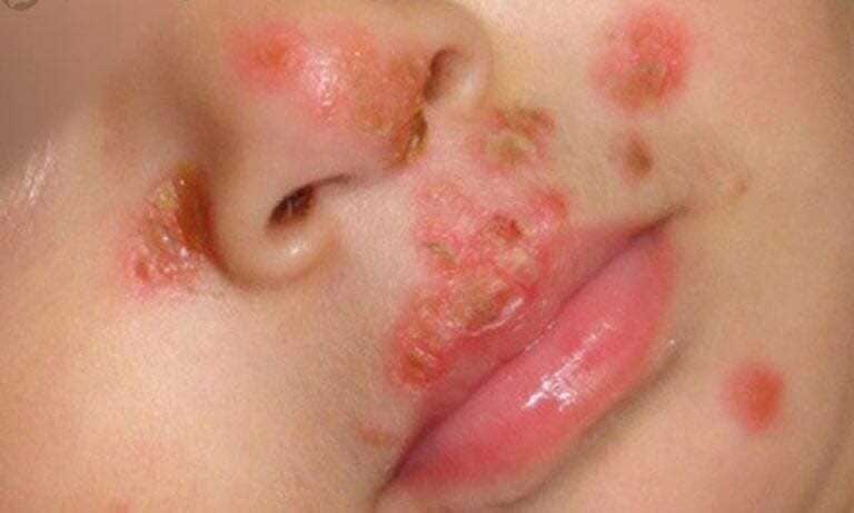 Bệnh Chốc (Impetigo) Là Gì?