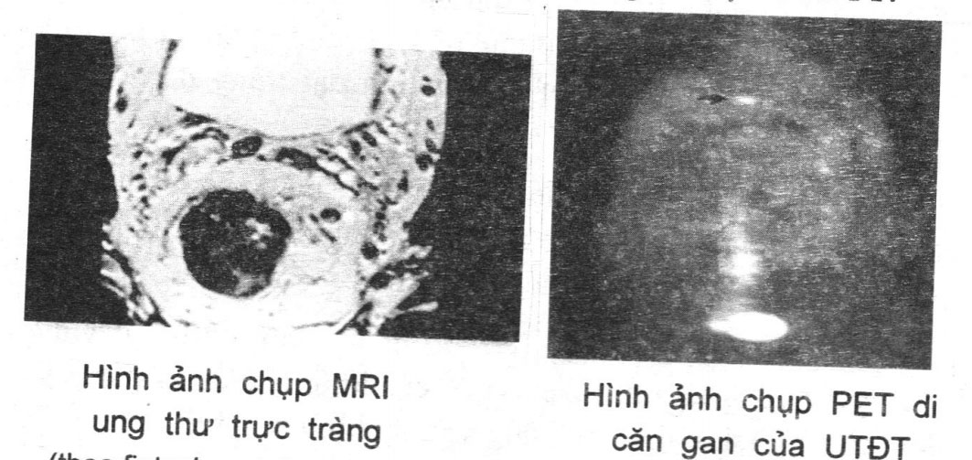 Chụp MRI