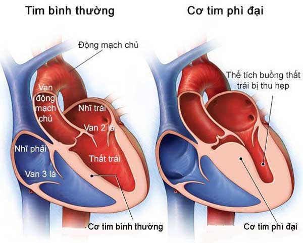 Bệnh Cơ Tim Phì Đại