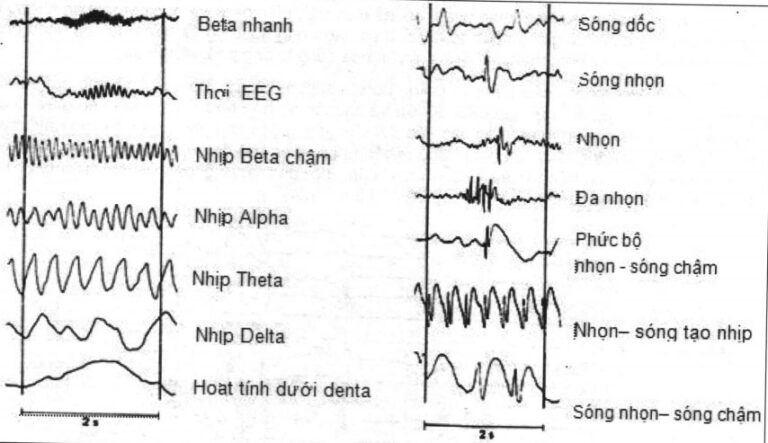 Nhịp sóng điện não đồ cơ bản