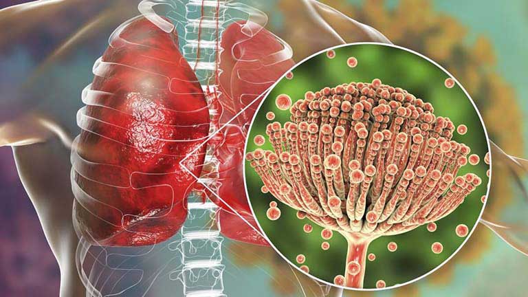 Nhiễm trùng nấm Aspergillus