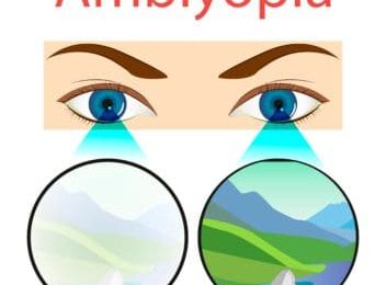 Bệnh nhược thị (amblyopia)