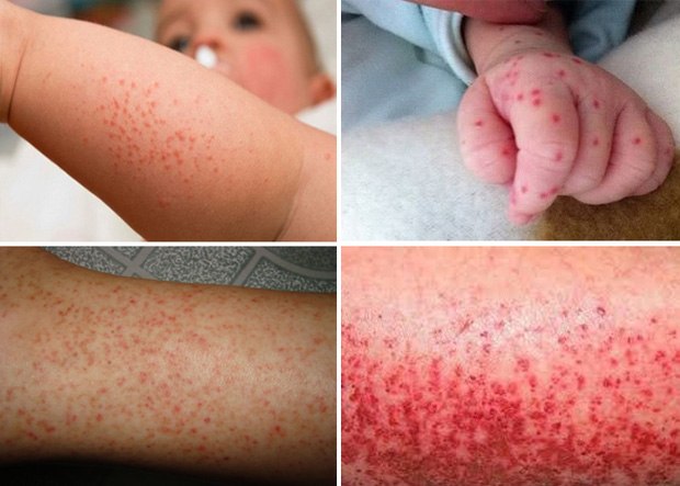 Hình ảnh xuất huyết dưới da trong bệnh sốt xuất huyết