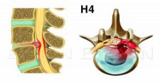 Hình ảnh thoát vị đĩa đệm