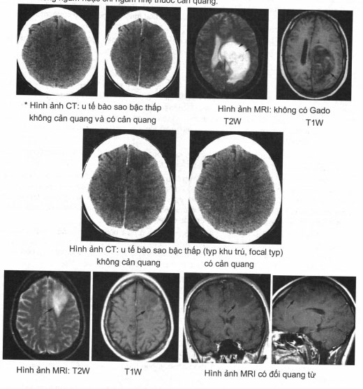 Chẩn đoán và điều trị U não