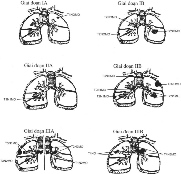 Chẩn đoán và điều trị Ung thư phổi
