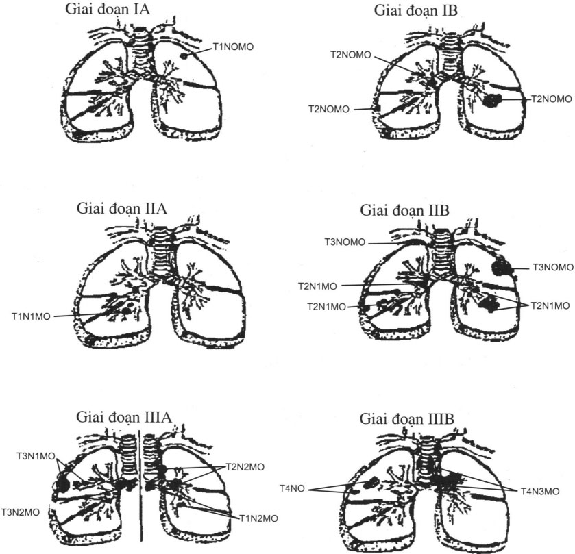 Phân chia giai đoạn ung thư phổi